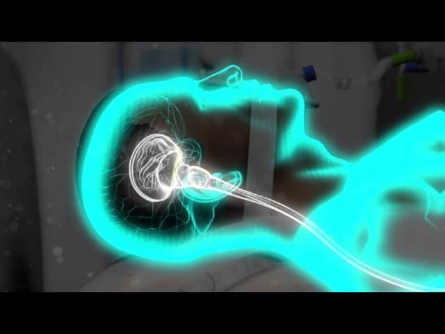 Coma Artificiel Infection Pulmonaire