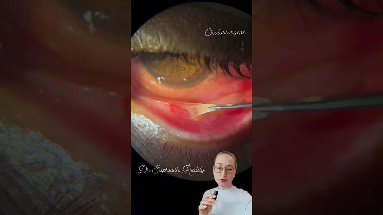Infection De L'oeil