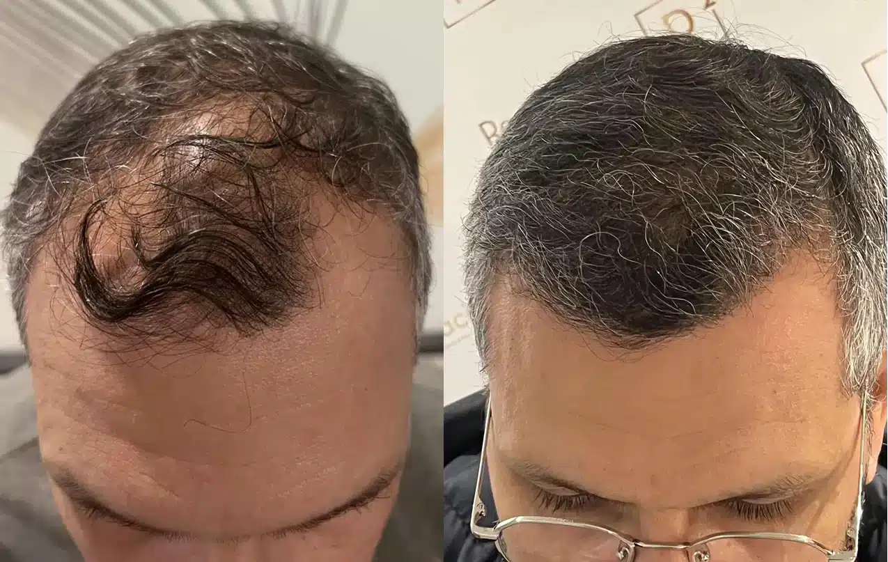 Comprendre la greffe de cheveux : étapes clés, bénéfices et limites avant de se lancer 1 avant apres greffe de cheveux racine carree
